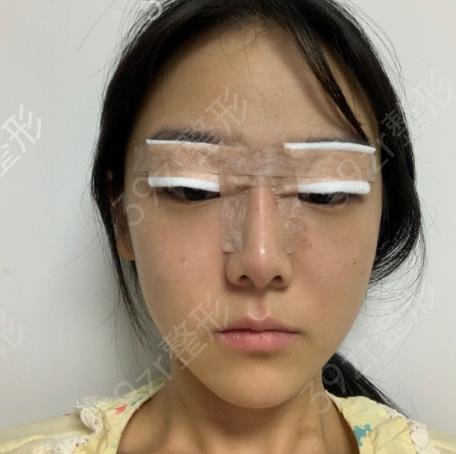 北京双眼皮修复牛的医生找这几位准没错