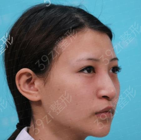 北京沃尔刘彦军鼻修复多少钱
