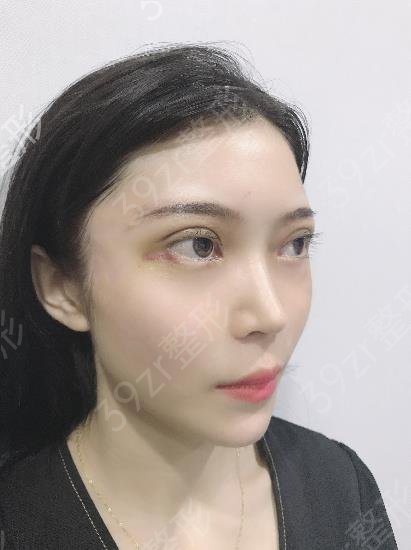 合肥做双眼皮好的整形医院推荐