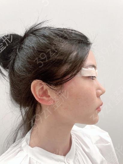 合肥做双眼皮好的整形医院推荐