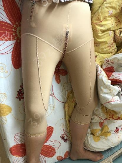 杭州哪家医院抽脂好