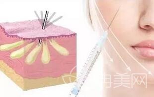 北京自体脂肪填充去哪里比较好