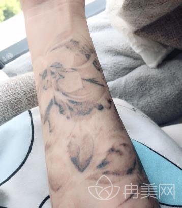 山东省立医院可以洗纹身嘛