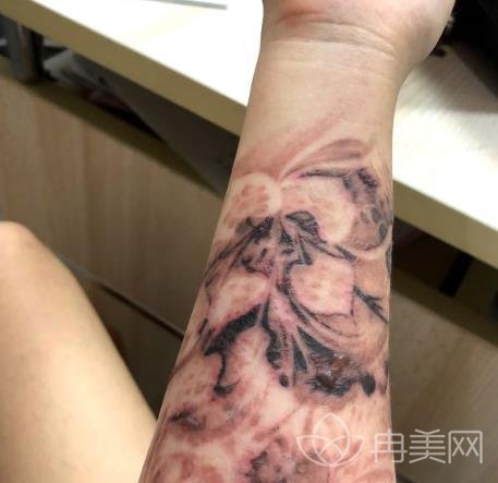 山东省立医院可以洗纹身嘛