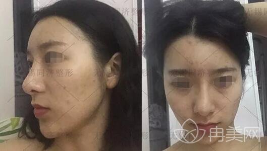 无锡同济整形脂肪全脸填充手术个人真实记录