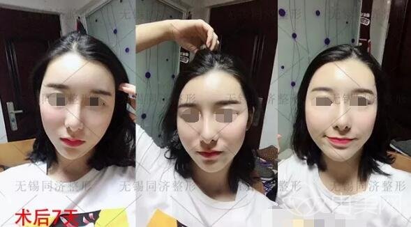 无锡同济整形脂肪全脸填充手术个人真实记录