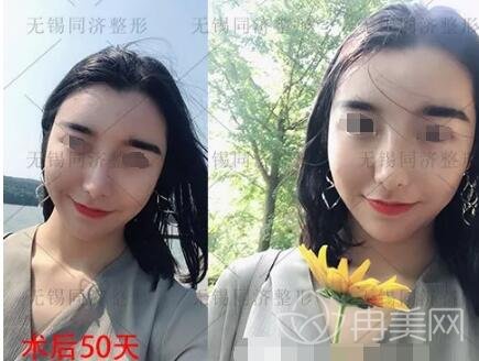 无锡同济整形脂肪全脸填充手术个人真实记录
