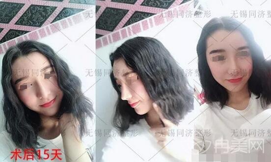 无锡同济整形脂肪全脸填充手术个人真实记录