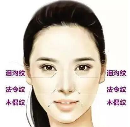 广州做去除法令纹好吗