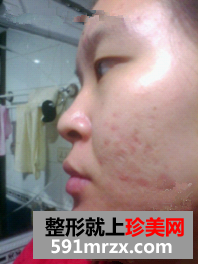大美妞的祛痘经历 屌丝女逆袭白富美