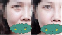 美女玻尿酸填鼻唇沟手术案例分享
