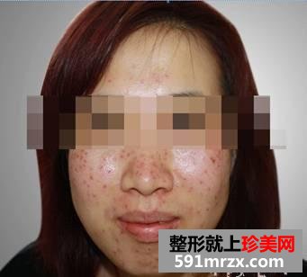 激光去雀斑塑造了一个更加自信的我