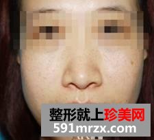 激光去雀斑塑造了一个更加自信的我