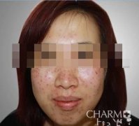 激光去雀斑塑造了一个更加自信的我