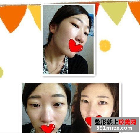 一个美女的缝线双眼皮&假体隆鼻的案例
