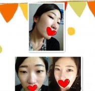 一个美女的缝线双眼皮、假体隆鼻的案例