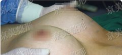 自体脂肪隆胸到京美自体脂肪隆胸前后对比图