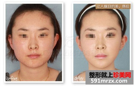 去颊脂垫手术效果好吗 去颊脂垫前后对比图