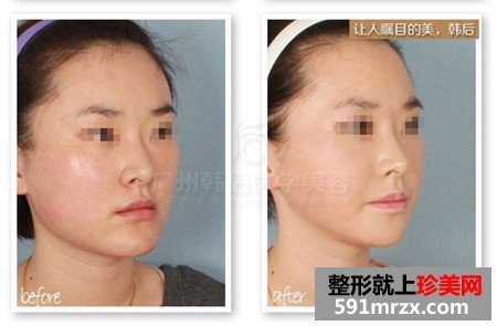去颊脂垫手术效果好吗 去颊脂垫前后对比图