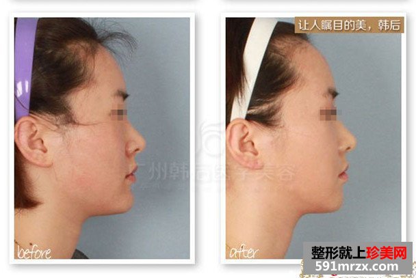 去颊脂垫手术效果好吗 去颊脂垫前后对比图
