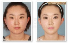 去颊脂垫手术效果好吗去颊脂垫前后对比图