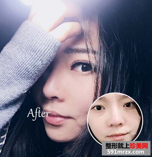全切双眼皮恢复过程前后对比真人案例效果照片图