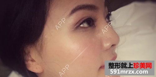 全切双眼皮恢复过程前后对比真人案例效果照片图
