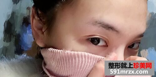 全切双眼皮恢复过程前后对比真人案例效果照片图