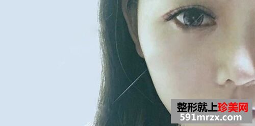 全切双眼皮恢复过程前后对比真人案例效果照片图