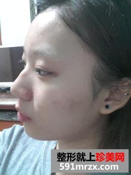 鼻翼缩小前后对比图,鼻翼缩小美丽日记