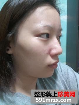 鼻翼缩小前后对比图,鼻翼缩小美丽日记