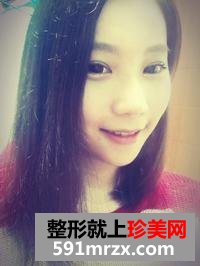 鼻翼缩小前后对比图,鼻翼缩小美丽日记