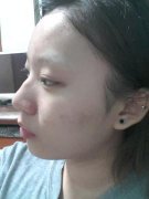 鼻翼缩小前后对比图,鼻翼缩小美丽日记