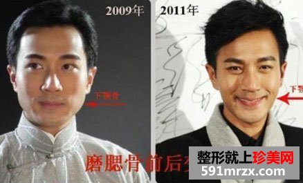 盘点娱乐圈男士下颌角整形成功案例 简直完美无痕