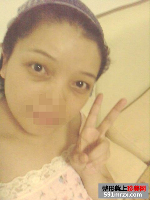 【外切眼袋】网友图片分享外切去眼袋全过程
