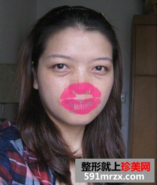 【外切眼袋】网友图片分享外切去眼袋全过程