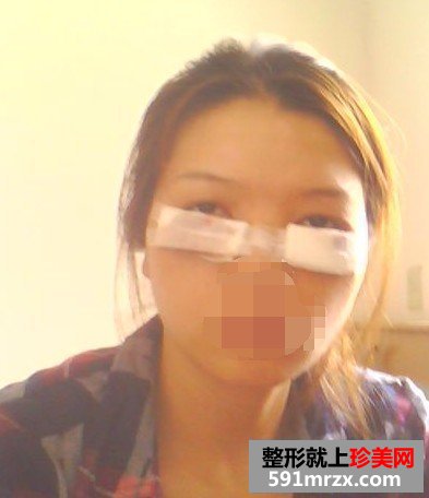 【外切眼袋】网友图片分享外切去眼袋全过程