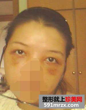 【外切眼袋】网友图片分享外切去眼袋全过程