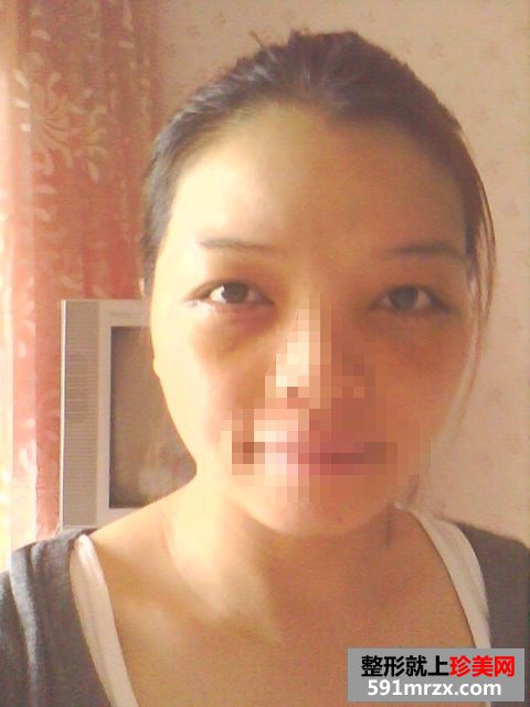 【外切眼袋】网友图片分享外切去眼袋全过程