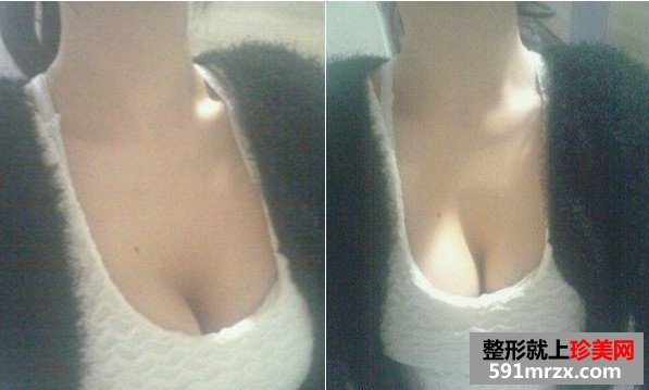 韩国隆胸整形经历