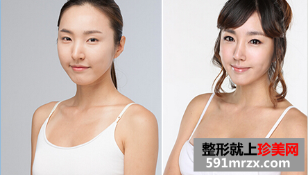 娜高假体隆胸多少钱 娜高假体隆胸案例