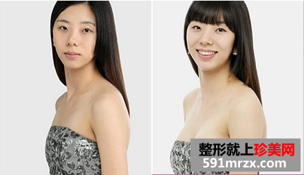 娜高假体隆胸多少钱 娜高假体隆胸案例