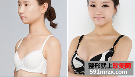 娜高假体隆胸多少钱 娜高假体隆胸案例