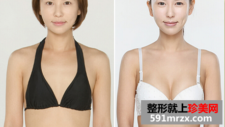 娜高假体隆胸多少钱 娜高假体隆胸案例