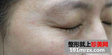 美女带妈妈一起体验玻尿酸除皱术