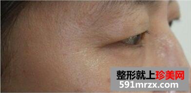 美女带妈妈一起体验玻尿酸除皱术