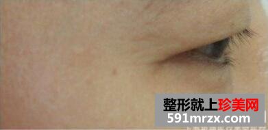 美女带妈妈一起体验玻尿酸除皱术