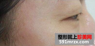 美女带妈妈一起体验玻尿酸除皱术