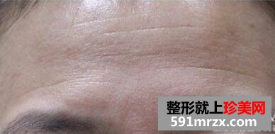 美女带妈妈一起体验玻尿酸除皱术