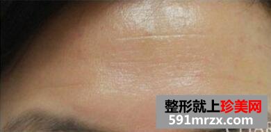 美女带妈妈一起体验玻尿酸除皱术